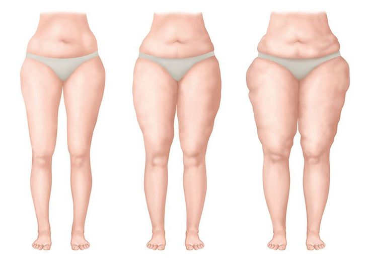 Lipödem Nedir ve Evreleri Nelerdir?